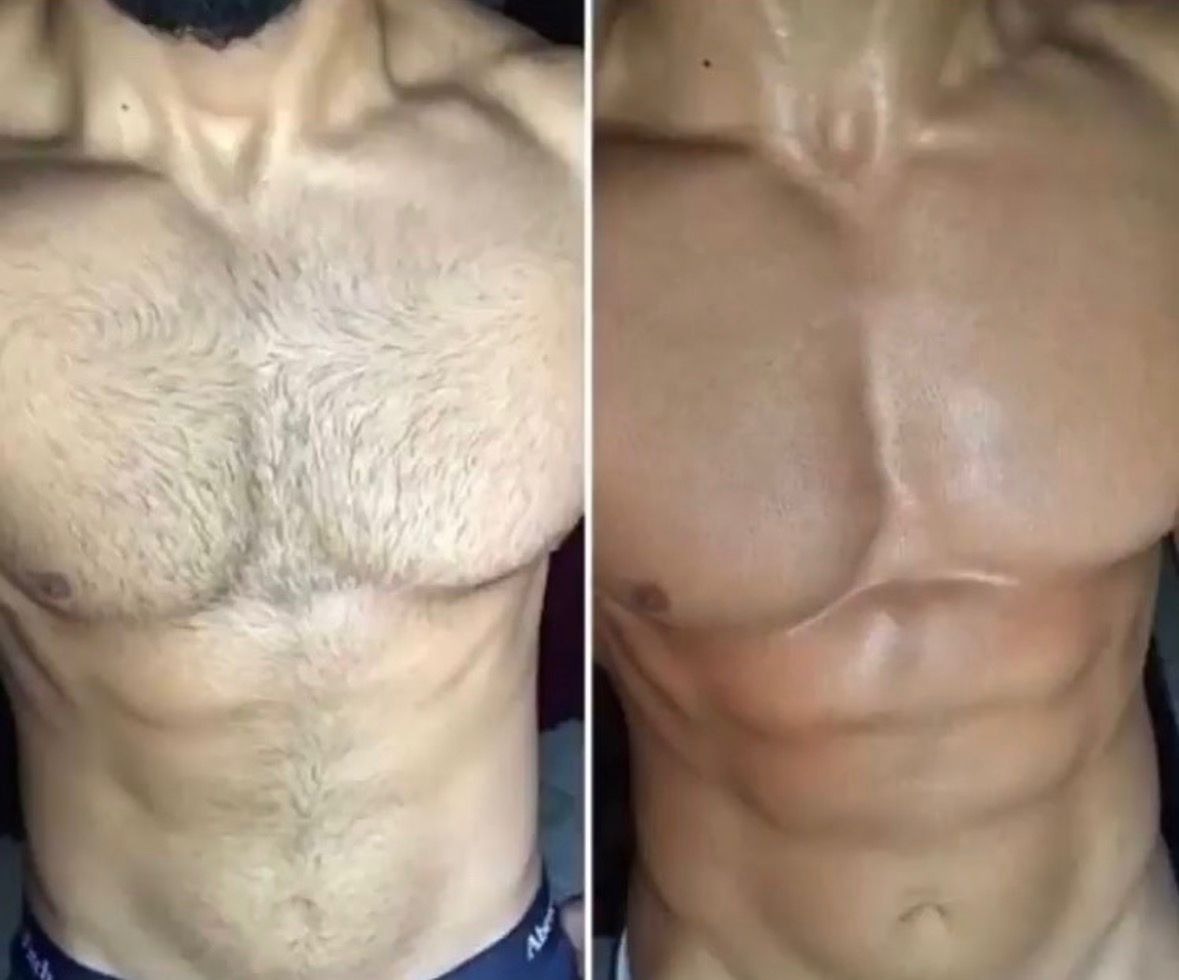 Résultat épilation torse homme avant après